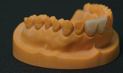Emax-Veneer